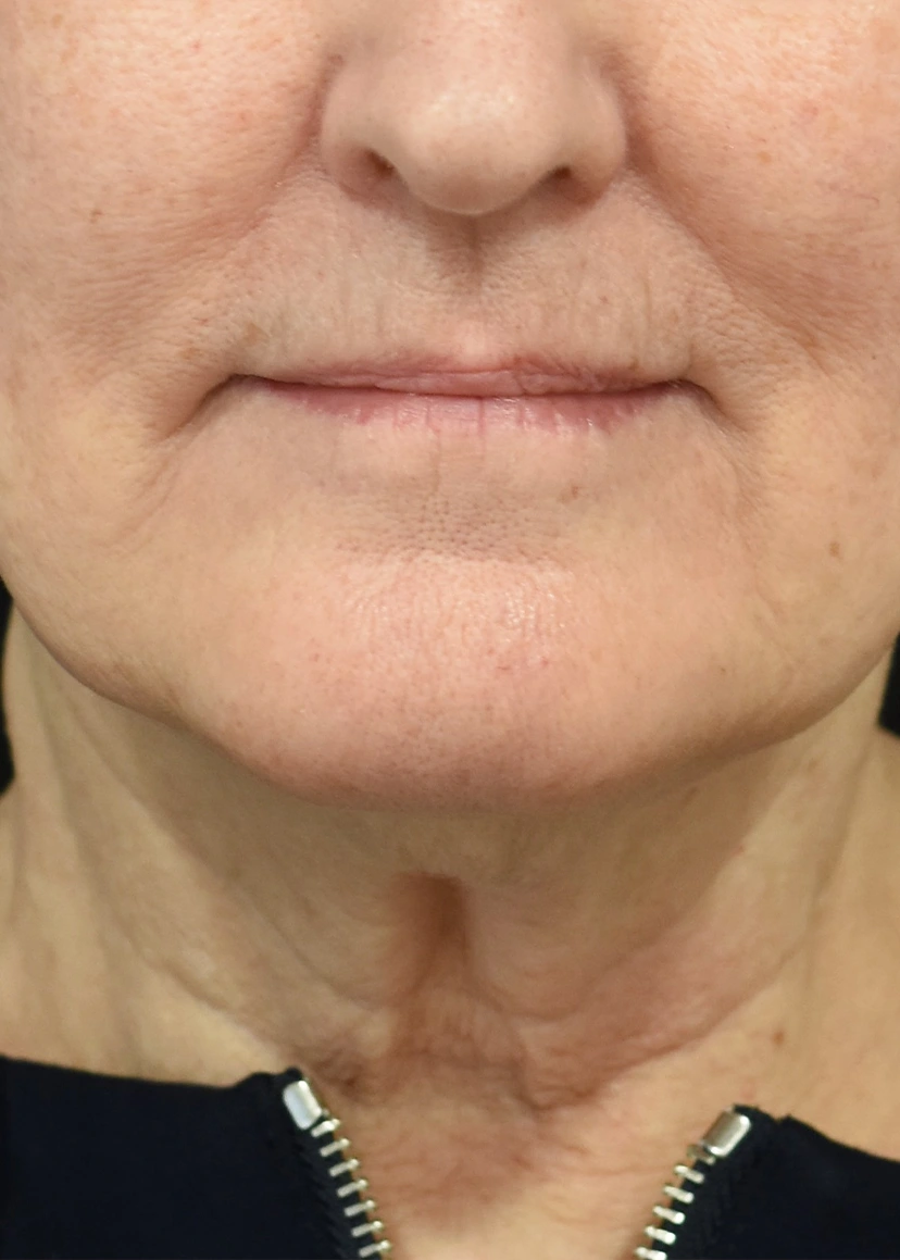 Deep Plane Facelift Patient 36 Set 1 Before